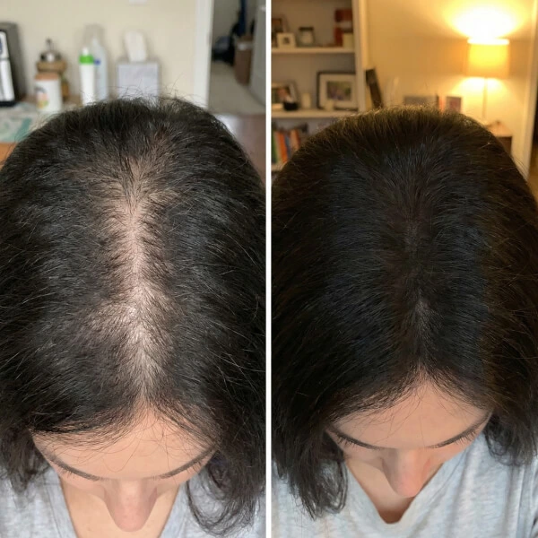 Side-by-side comparison showing a person’s scalp before and after treatment, with visibly thinner hair on the left and fuller hair on the right.