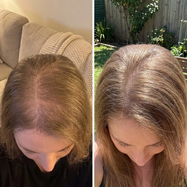 Split image shows the top of a woman's head before and after; the left side has thinning hair, while the right side shows noticeably thicker hair.