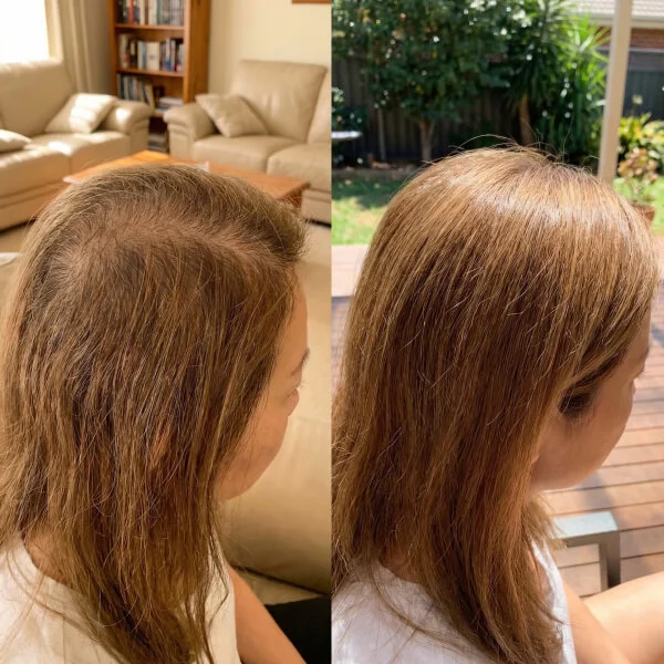 Side-by-side comparison of a woman's scalp showing thinning hair on the left and fuller, thicker hair on the right in similar environments.
