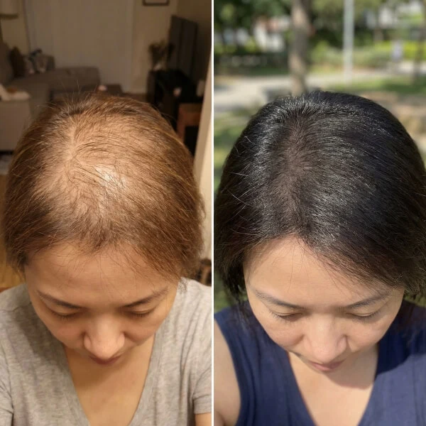 Comparison of a woman’s scalp before and after hair regrowth; left shows significant thinning, right shows fuller, thicker hair.