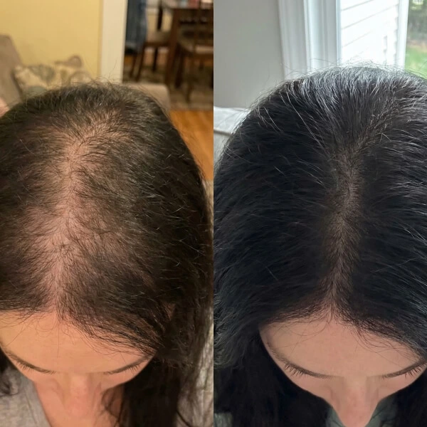 Side-by-side comparison of a woman’s scalp, showing thinning hair on the left and noticeably fuller, darker hair on the right.
