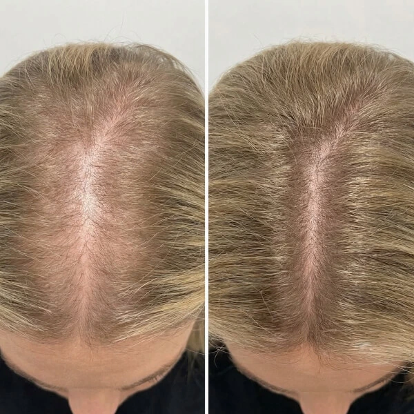 Side-by-side comparison of the top of a person's head showing thinning hair on the left and visibly fuller hair with less scalp showing on the right.