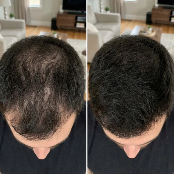 Top view of a person's head showing a before and after comparison of hair, with thinning hair on the left and fuller hair on the right.
