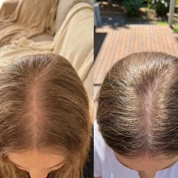 Two side-by-side photos show the top of a person's head before and after, highlighting reduced scalp visibility and thicker hair in the after image.