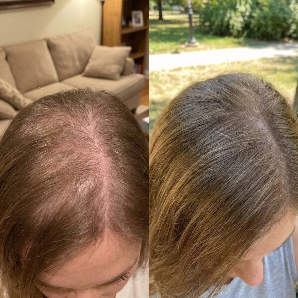 Side-by-side comparison of a person's scalp before and after hair regrowth treatment, showing increased hair density in the after image.