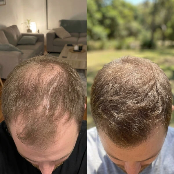Side-by-side comparison of a man's scalp before and after hair restoration, showing increased hair density in the after image.