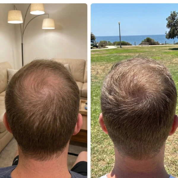 Side-by-side comparison of the back of a person's head, showing hair thinning in the left image and visibly fuller hair in the right image, both taken from the same angle.