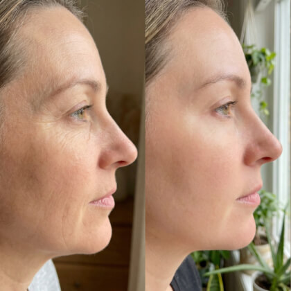 Side-by-side comparison of a woman's face showing visible reduction in wrinkles and smoother skin in the "after" image on the right.