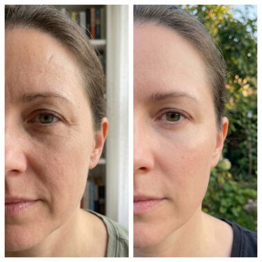Side-by-side close-up photos of a woman's face showing her skin before and after treatment, with reduced wrinkles and smoother texture in the after image.
