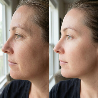 Side-by-side comparison of a woman's face before and after treatment, showing reduced wrinkles and smoother skin in the after image.