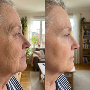 Side-by-side profile photos of an older woman before and after a skin treatment; the "after" image shows smoother skin and fewer wrinkles.