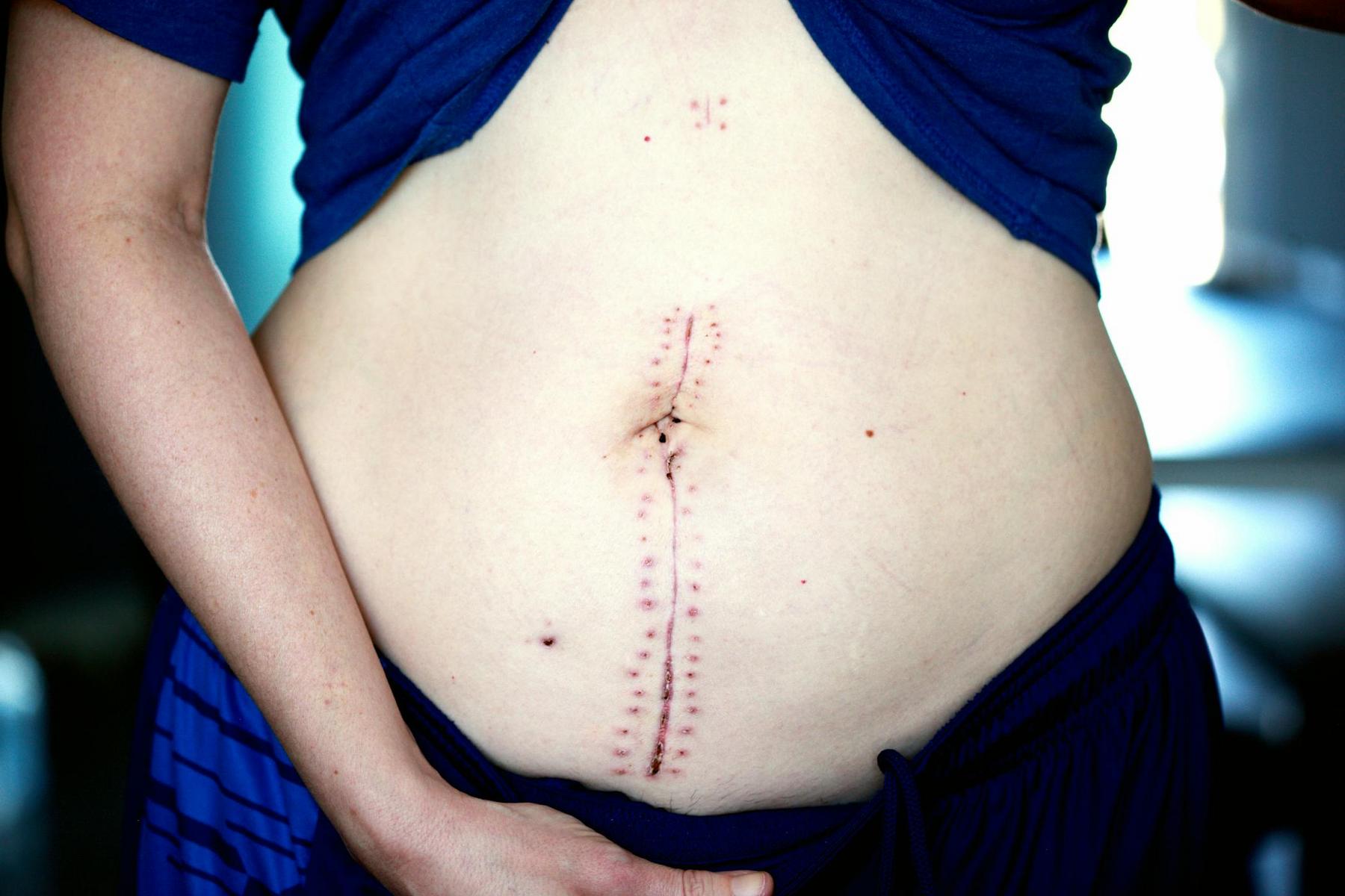 A close-up of a person's abdomen showing a vertical surgical scar with stitches and healing marks; the person is wearing blue clothing.